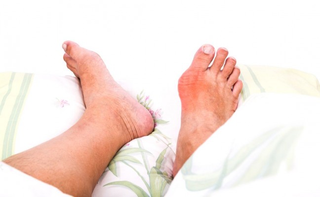 Naturally cure gout